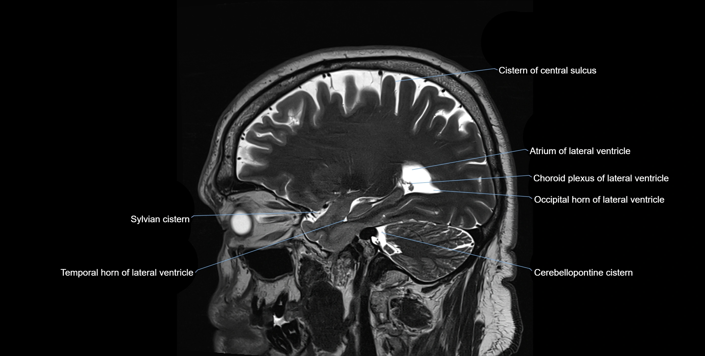 Brain cisterns  and ventricles sagittal anatomy 3T MRI image-img-00001-00017.webp